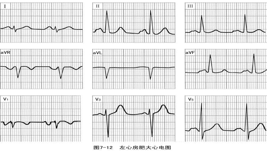 临床巧计异常心电图