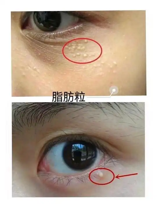 哪种医美项目可以消除脂肪粒?