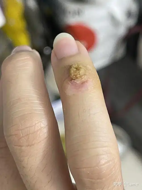 记录我的冷冻疣过程.慎点图 略恶心哈哈哈