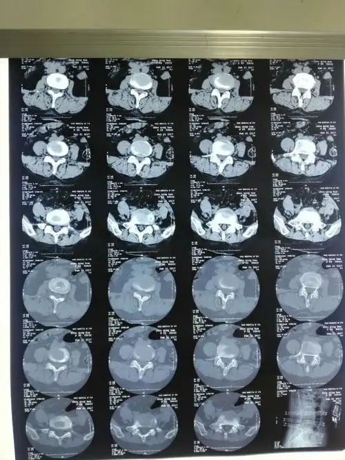 腰5骶1极外侧椎间盘突出症椎间孔镜治疗 - 美篇