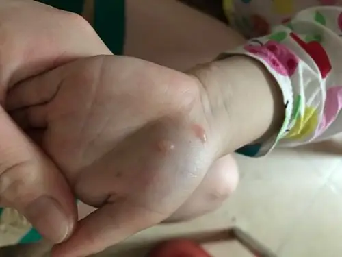 小孩身体上反反复复有这样型的疱疹出现,请问是什么原因引起吗?