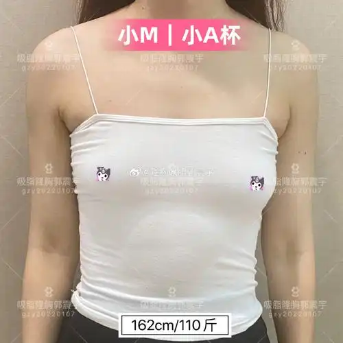 74【宝妈小m-11集】ceffe03自体脂肪隆胸1年1个月反馈:小a 79