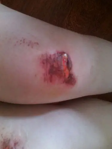 我腿在三天前摔伤我一直用双氧水擦伤口好像有一点化脓了请