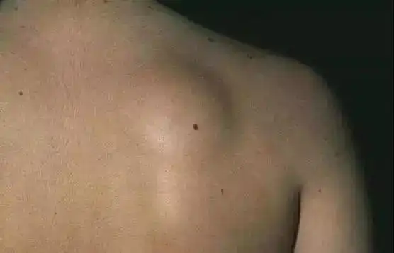 骨小雅课堂身上突然长出个肉疙瘩要不要紧