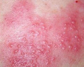 皮肤科高广程主任  根据患者发来的照片表现为念珠菌龟头炎,由于闹殚