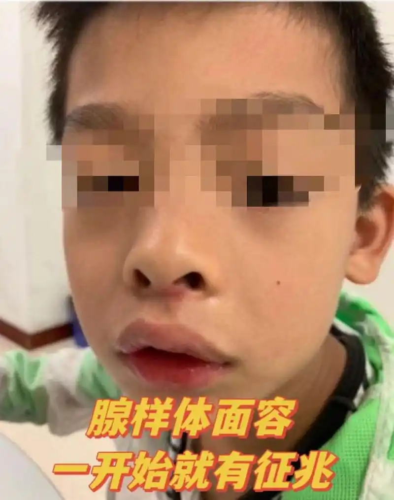 腺样体面容在一开始就有征兆了!