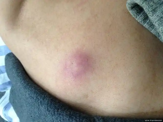 病史 患者自述1年前左侧背部出现黄豆大小结节,质硬,皮肤表面颜色正常