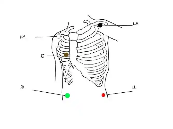 心电监护五个电极位置图