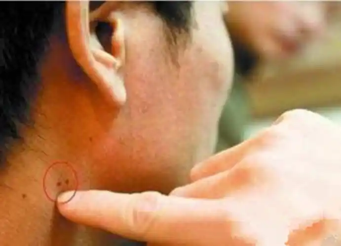 尖锐湿疣菜花初期图片