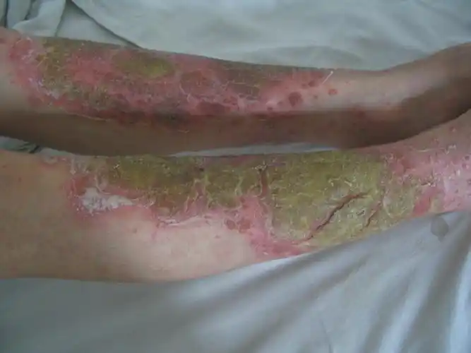 脓疱性银屑病治疗前后 - 皮肤及性传播疾病讨论版 - 爱爱医医学论坛