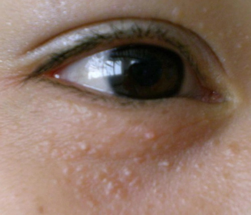 扁平疣长什么样子扁平疣图片