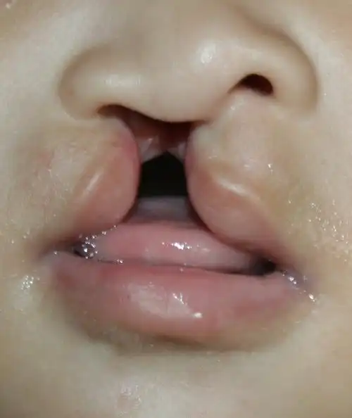 唇腭裂_唇腭裂治疗方式 - 好大夫在线
