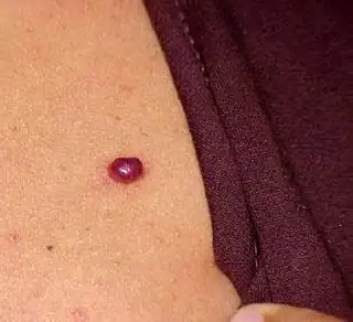 哪些食物适合血管痣患者食用