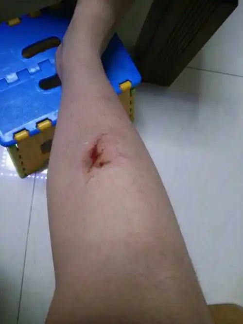 腿上的伤口,今天下午汽车时腿撞在了路边的圆柱型保护栏是了,该怎么