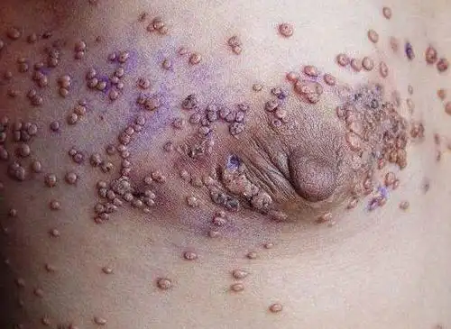 艾滋病什么症状最明显 艾滋病什么症状最明显图片- 育儿指南