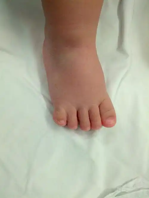 并趾手术_先天性足畸形_手术_治疗方式 - 好大夫在线