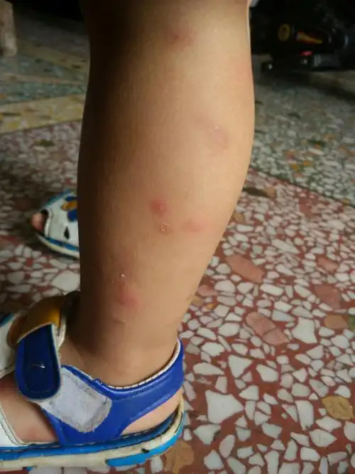 宝宝身上出红点疱疹是什么原因