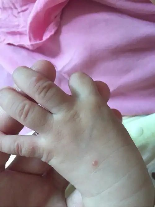 宝宝被蚊子咬了之后变成这个样子了