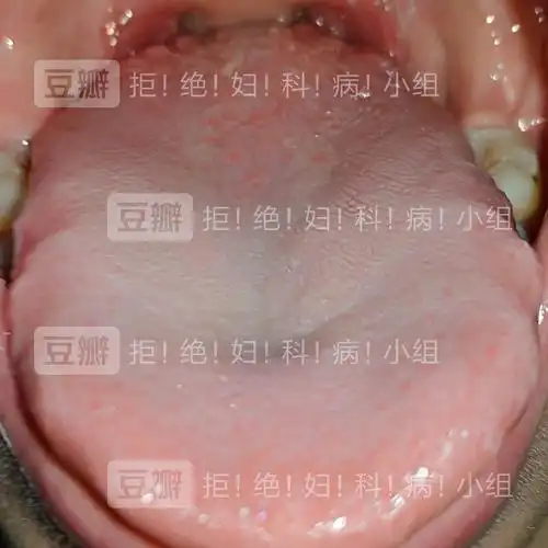 求问舌头这样子是hpv吗