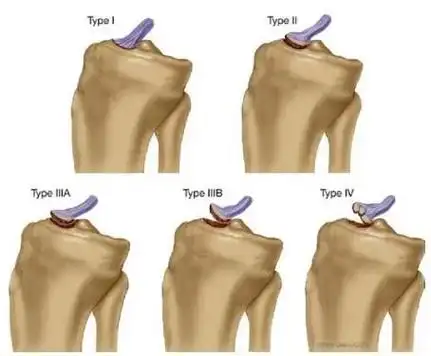 易漏诊的胫骨髁间嵴骨折,这样处理就对了!