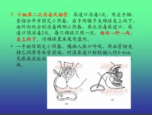 一次性为女病人导尿术操作流程详解图