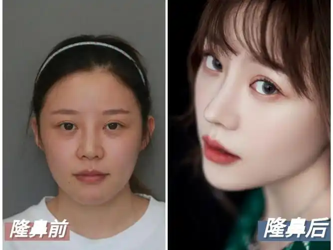 福州爱美尔朱刚强鼻综合整形案例术后45天对比照片一