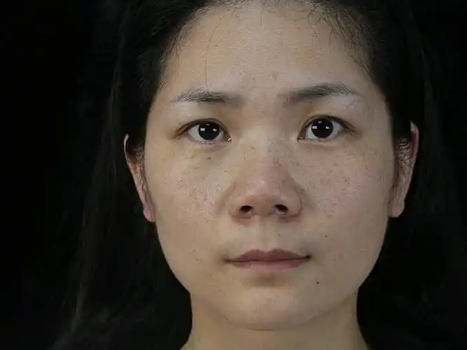 遗传性雀斑该如何治疗(遗传性雀斑该如何治疗呢)