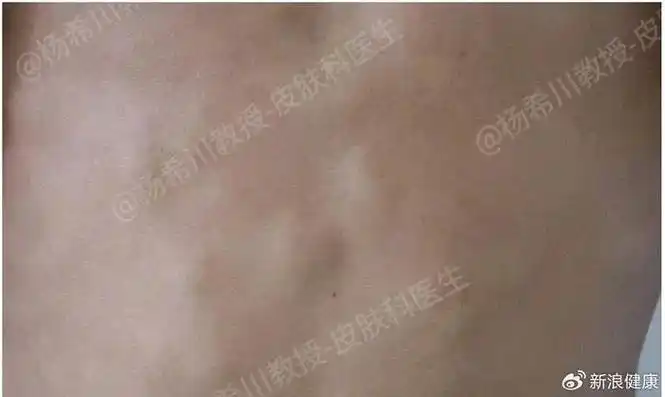 痘痘,囊肿,脂肪瘤,它们仨有啥区别?