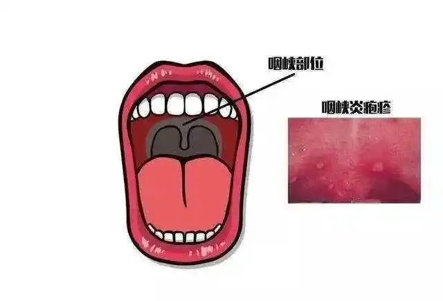 这种病毒进入感染高发季,5岁以下儿童为高发人群|疱疹|咽峡炎|传染性