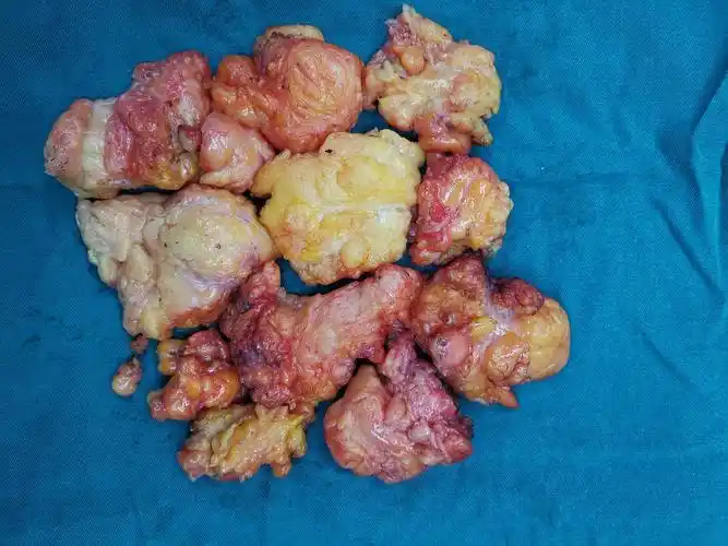 miccoli手术拓展:一例颈后巨大脂肪瘤切除的感悟