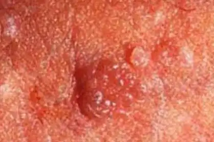 女性尖锐湿疣早期症状图片都有哪些呢