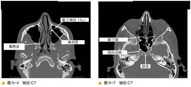 超清图解鼻窦及颅底ct解剖