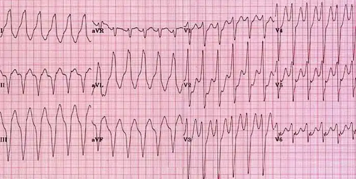 识"图"寻踪_室性心动过速_心脏性猝死_icd_医脉通