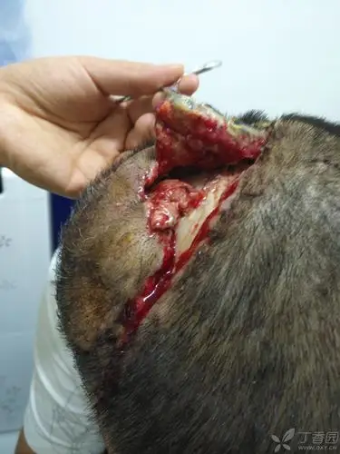 头部脂肪瘤术后感染切口裂开