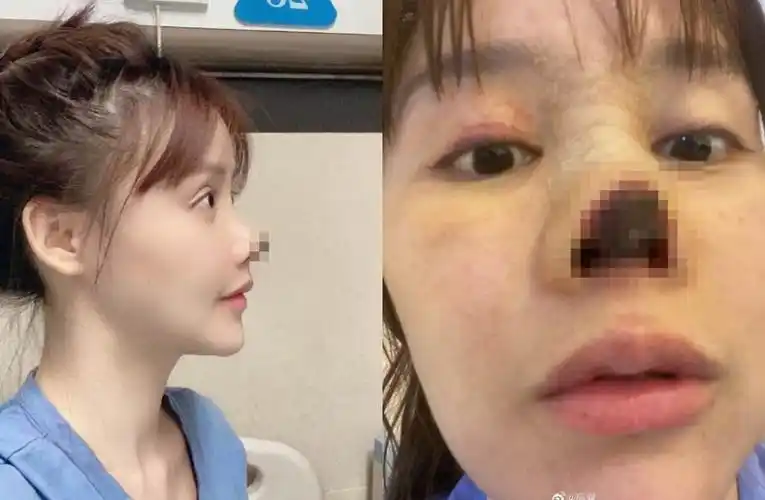 女星整形失败毁容鼻头缺一角,诊所罚金超低_腾讯新闻