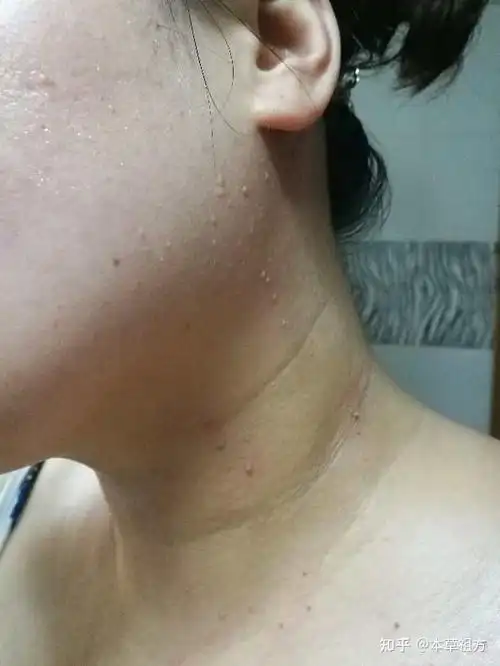 怀孕就开始长丝状疣越长越多怎么回事