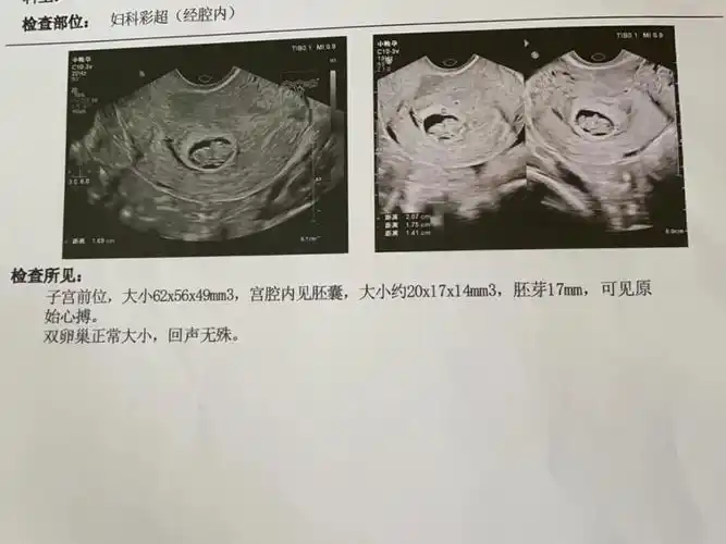 孕8周 2天 孕囊小 hcg翻倍差
