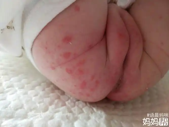 回答您好,宝宝的红屁股是比较正常的 不过您的宝宝比较严重的话,建议