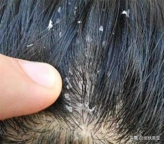 守护皮肤防御病袭# #科普一下# #皮肤健康科普# #把健康带回家