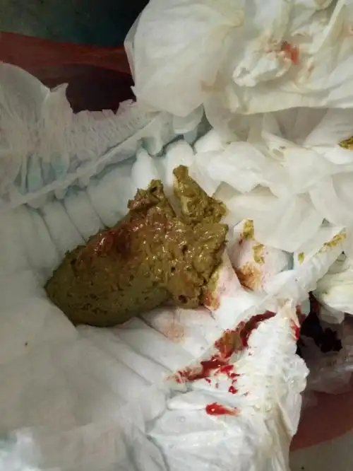 宝宝7个月大便出血怎么回事啊