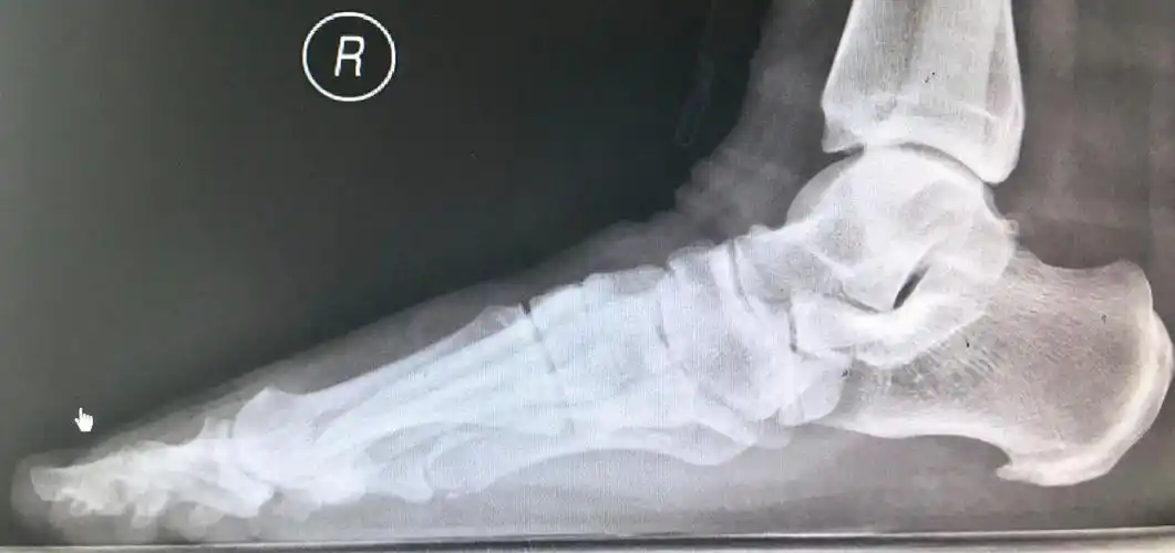 跟骨骨刺与跟痛症—一场医患共同参与的围剿战 - 好大夫在线