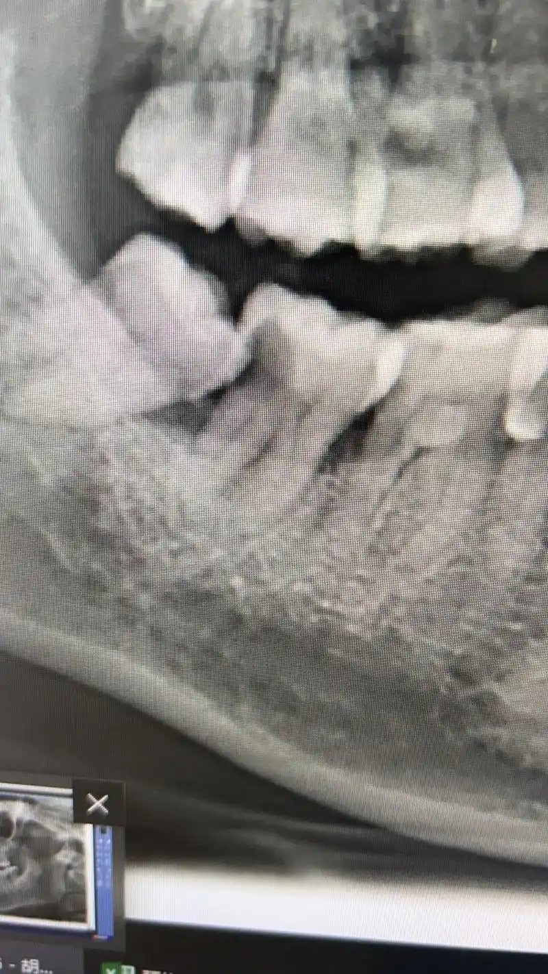 有这类的智齿早点拔吧留着有害无益啊