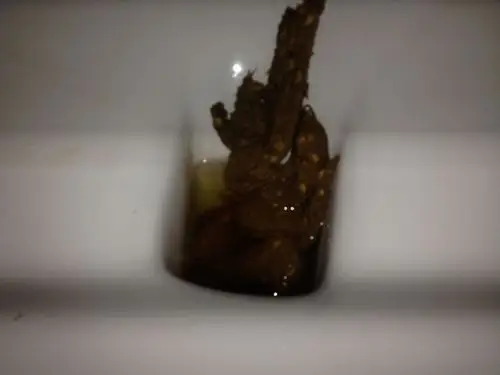 那里面是啥,我拉的屎里面怎么会有这些豆大的东西?我没吃什么啊!