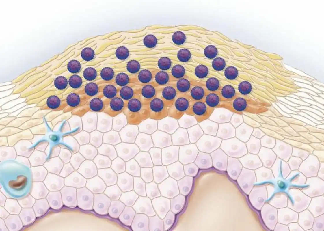 皮肤疣是由人乳头瘤病毒感染皮肤和黏膜上皮,所引起的良性增生性