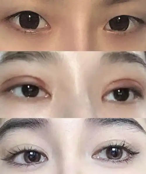 平行双眼皮恢复案例