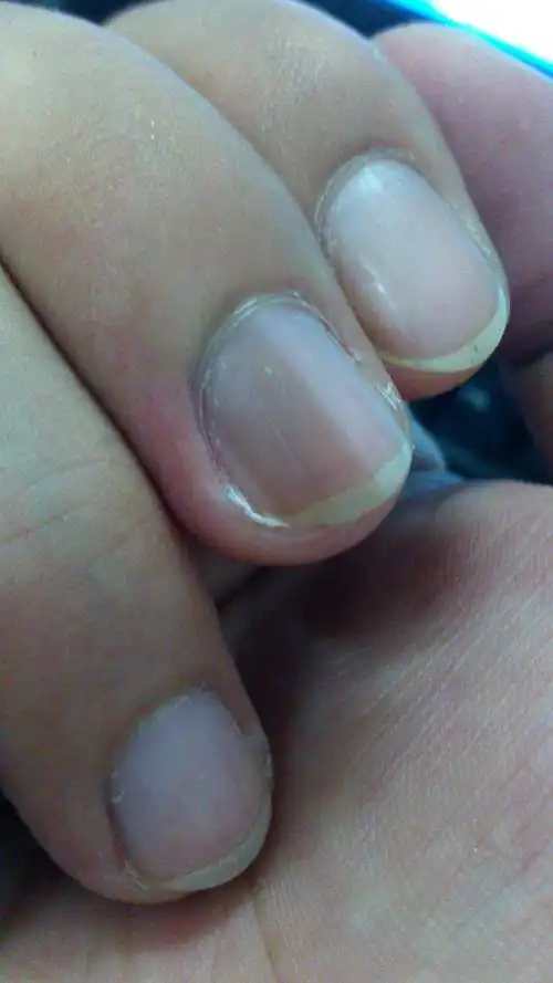 请问我这个手指算不算灰指甲?该怎么治疗呢