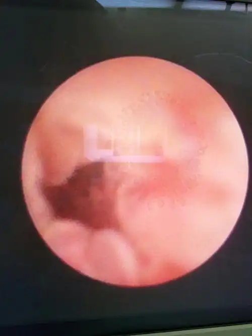 输尿管结石刺激引起的息肉,狭窄