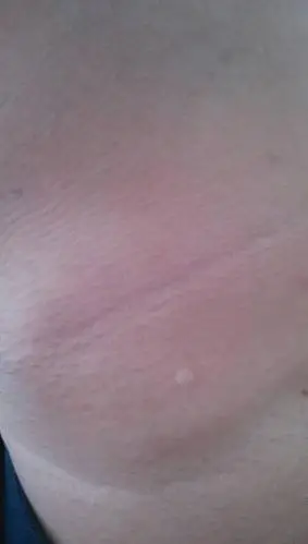 脖子上起一个白色的东西,有些突出正常皮肤,没有任何感觉,这是什么