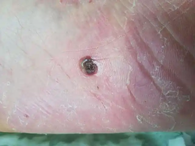 寻常疣瘊子要尽早治疗