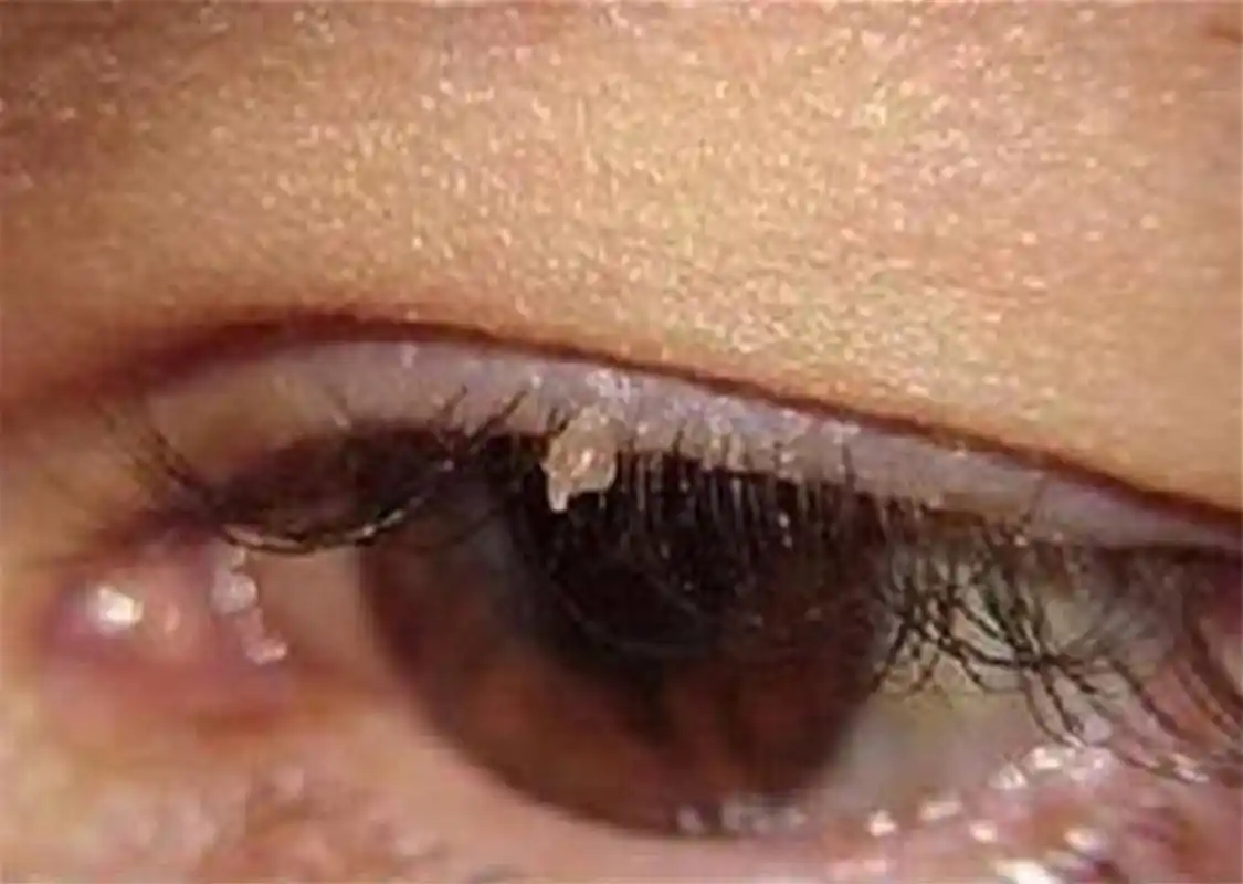 丝状疣是由hpv感染引起的一种皮肤疾病,常见于脸部,眼睑周围,嘴唇